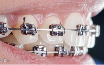 Dental Braces