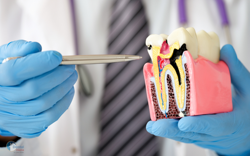 Tooth cavity: Dental Caries