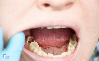 Tooth cavity: Dental Caries