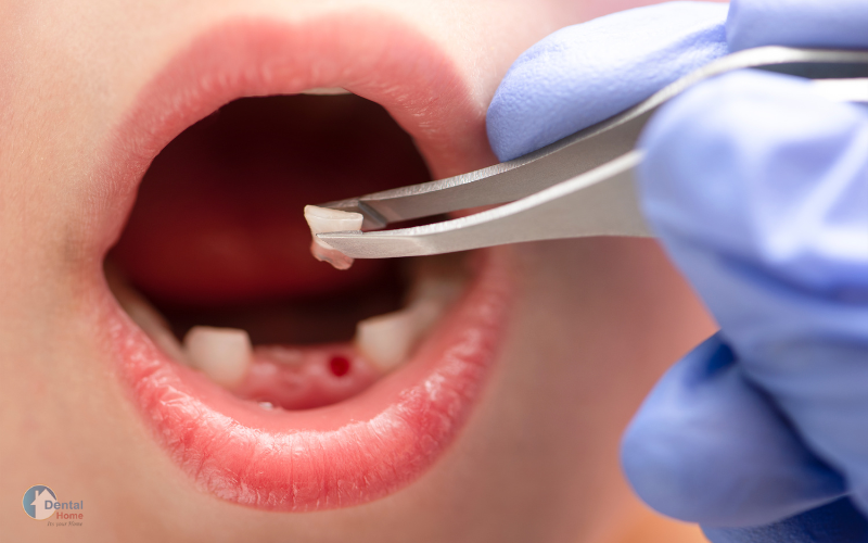 Treatment of a broken tooth