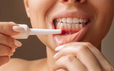 Common ulcers of the oral cavity