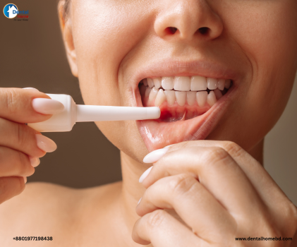Common ulcers of the oral cavity