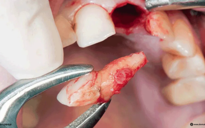 Surgical Extraction