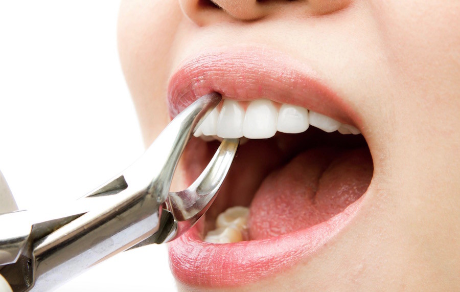 surgical extraction