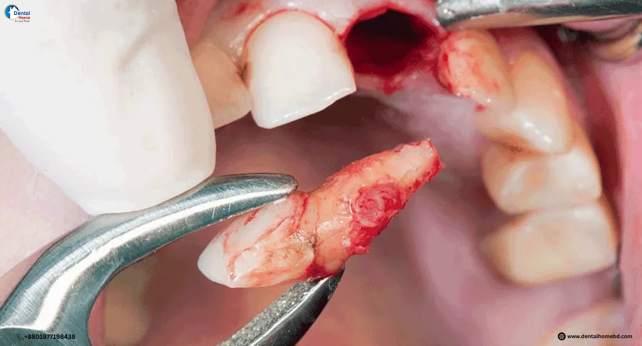 surgical extraction