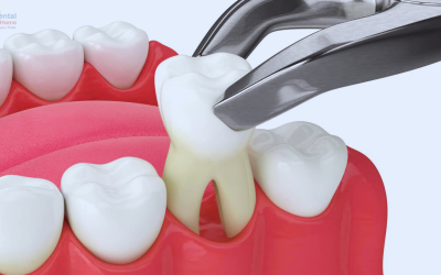 Benefits of Tooth Extraction