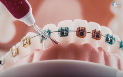 Benefits of dental braces