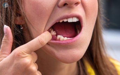 Wisdom Tooth Extraction