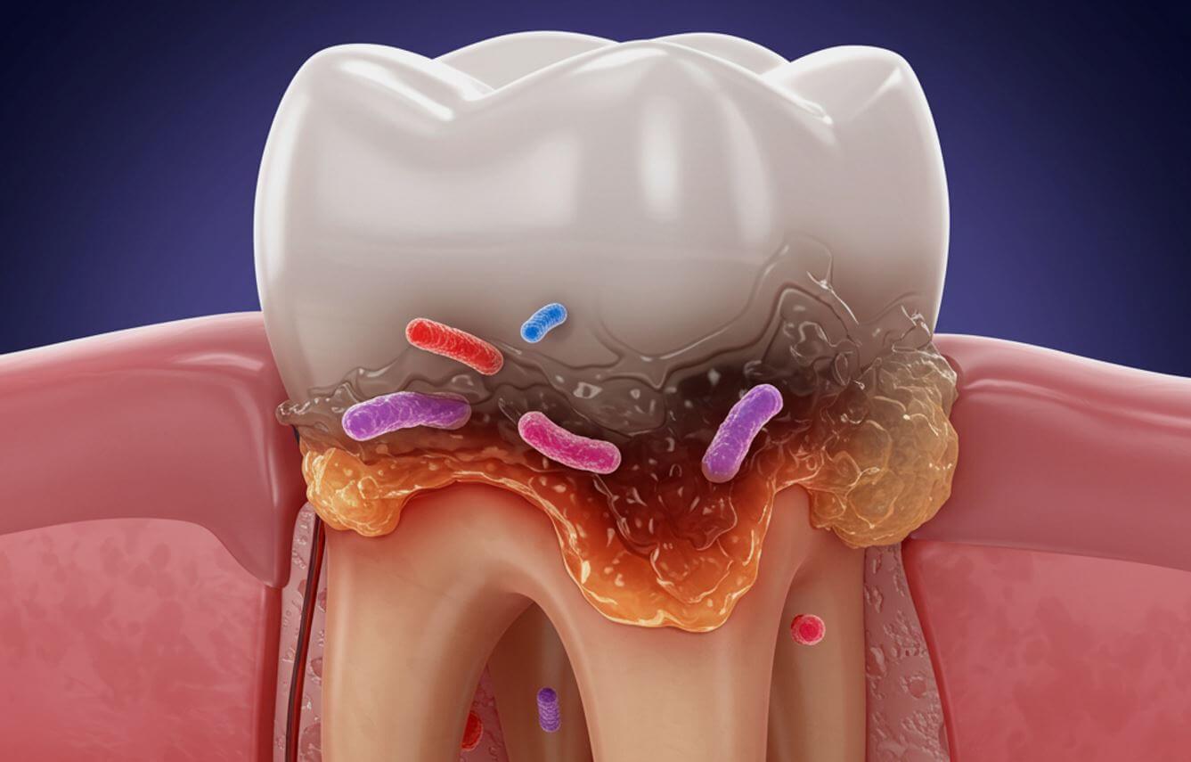 Tooth infection